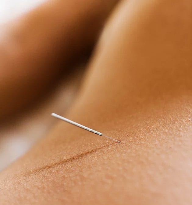 A close-up of an acupuncture needle inserted into a person's skin.