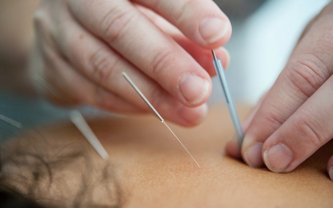 How Does Acupuncture Improve Body Wellness?