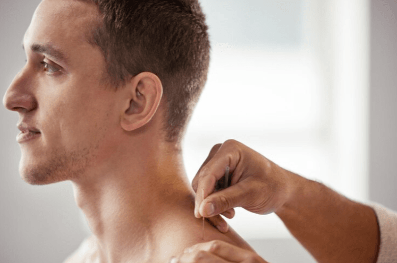 A person receives acupuncture with a thin needle inserted into their upper back near the shoulder, a technique often used to help support immunity.
